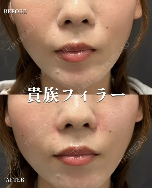 貴族フィラー after画像 メイン用