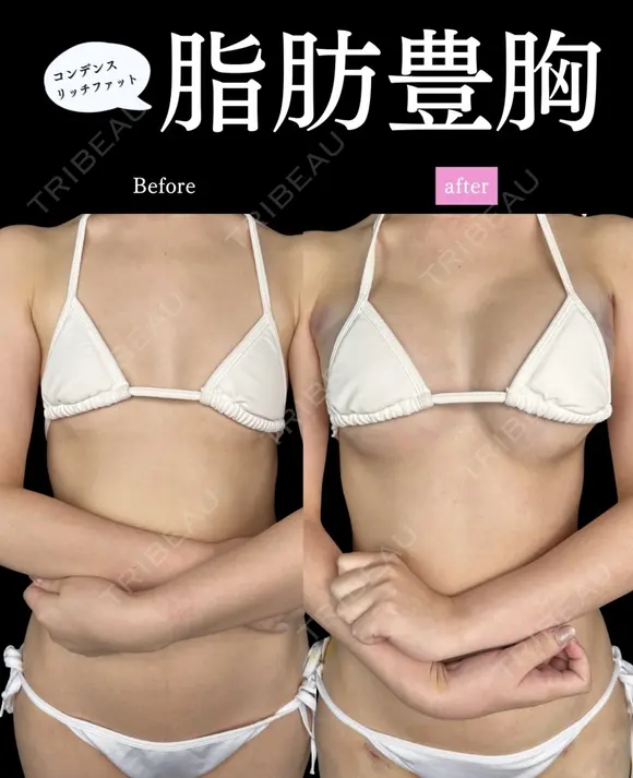 コンデンスリッチファット豊胸 after画像 メイン用