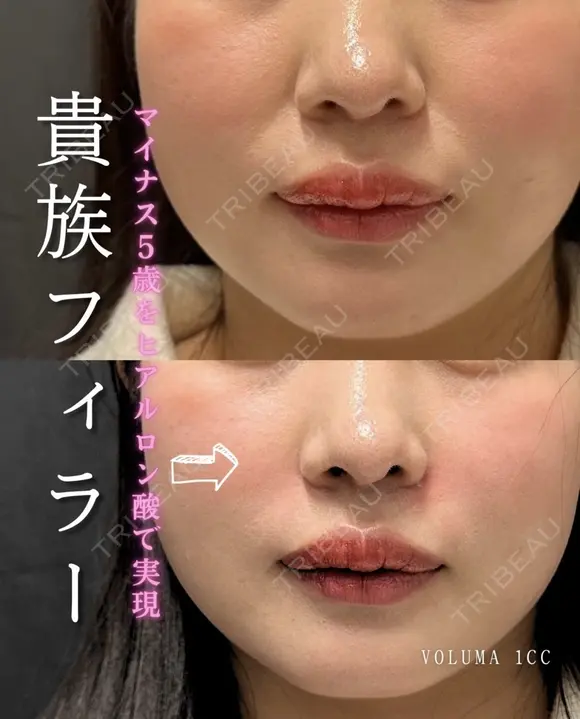 貴族フィラー before画像 メイン用