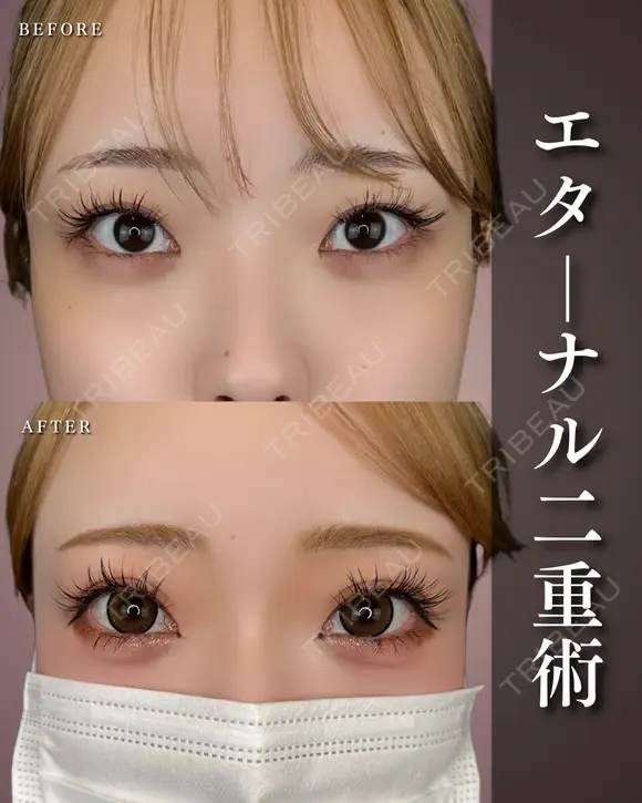 エターナル二重術 after画像 メイン用