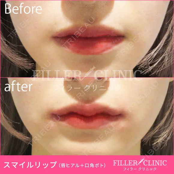 【スマイルリップ💋】唇ヒアルロン酸+口角ボト before画像 メイン用