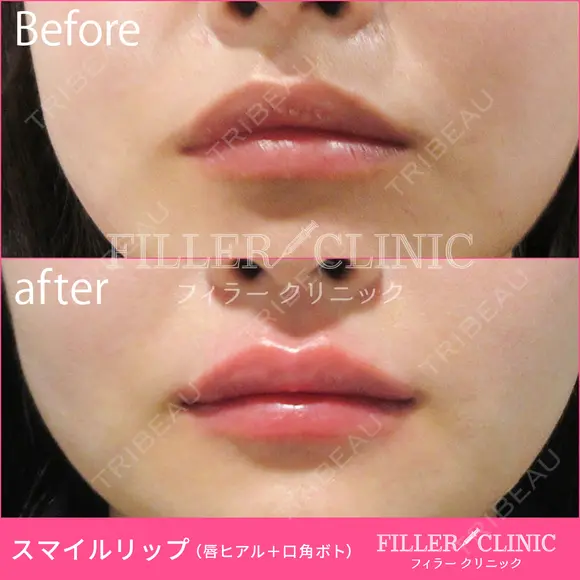 【スマイルリップ💋】唇ヒアルロン酸+口角ボト before画像 メイン用