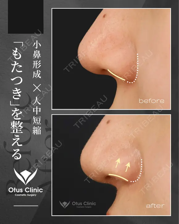人中短縮・鼻翼縮小・鼻翼挙上・鼻孔縁挙上 after画像 メイン用