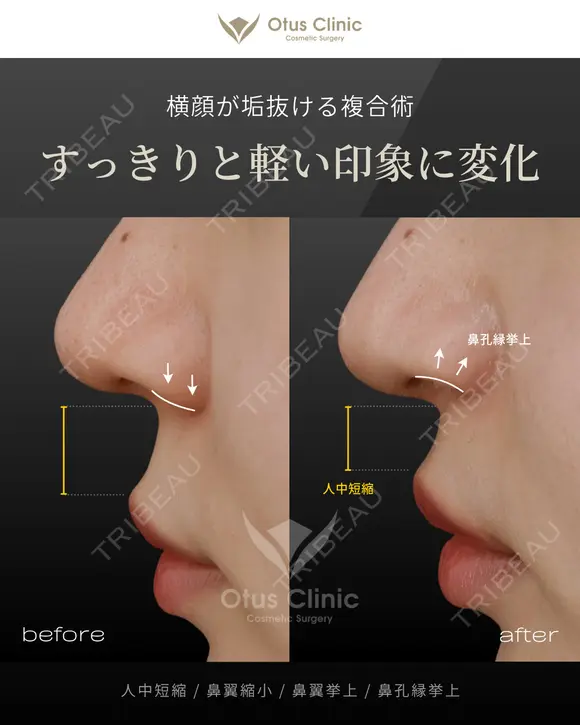 人中短縮・鼻翼縮小・鼻翼挙上・鼻孔縁挙上 before画像 メイン用