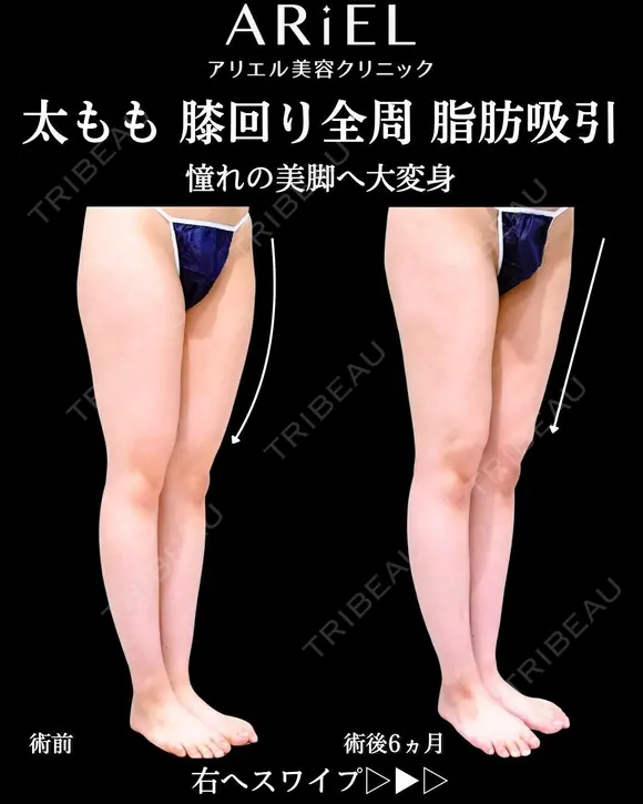 太もも　膝全周　脂肪吸引 180日後 メイン用