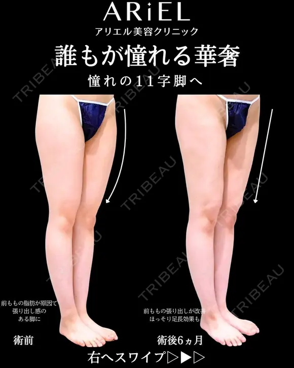 太もも　膝全周　脂肪吸引 before画像 メイン用