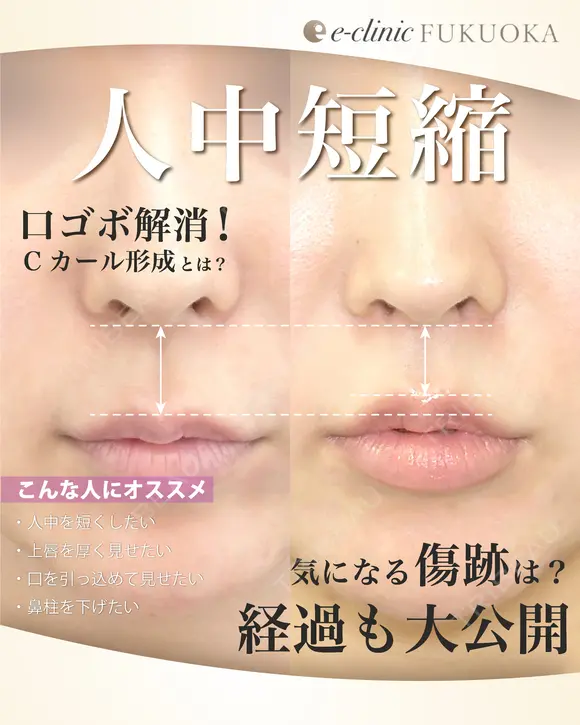 人中短縮 after画像 メイン用