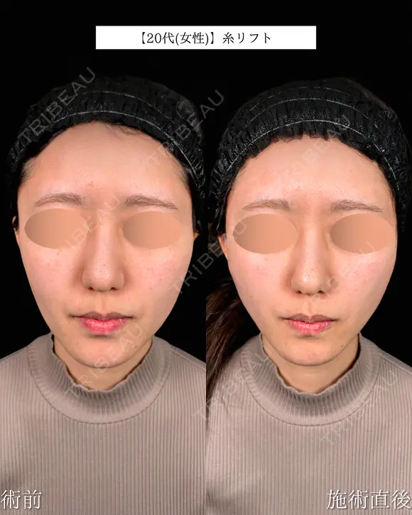 山本による🎀糸リフト🎀 before画像 メイン用