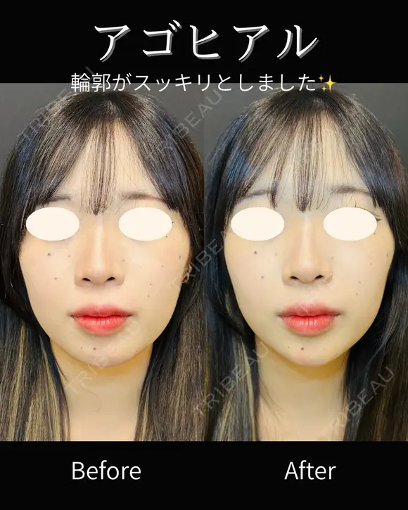 アゴヒアル 0日後 メイン用