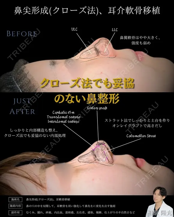 【鼻整形】鼻尖形成クローズ法＋耳介軟骨移植 before画像 メイン用
