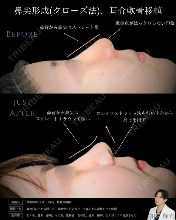 【鼻整形】鼻尖形成クローズ法＋耳介軟骨移植 after画像 メイン用
