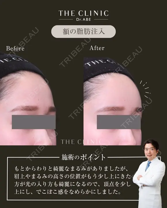 盛れる額GET✨｜顔の脂肪注入（額・こめかみ） after画像 メイン用