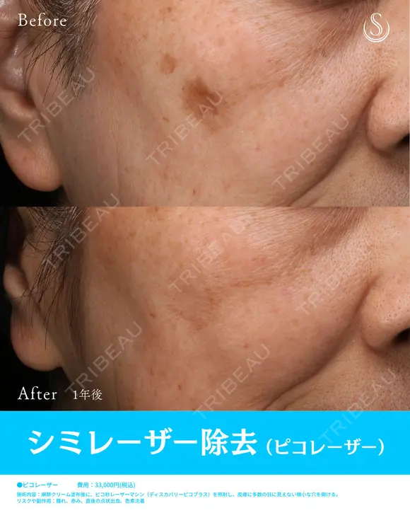シミレーザー除去(Picoレーザー) after画像 メイン用