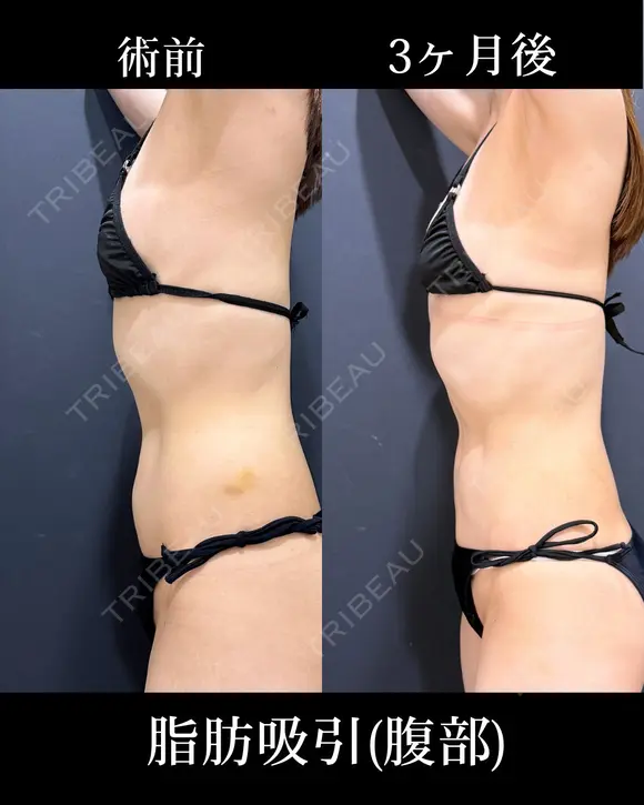 腹部脂肪吸引 before画像 メイン用
