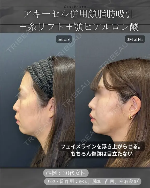 顔脂肪吸引、糸リフト、ヒアルロン酸注入(顎) before画像 メイン用