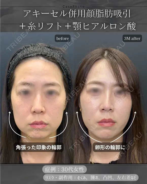 顔脂肪吸引、糸リフト、ヒアルロン酸注入(顎) after画像 メイン用