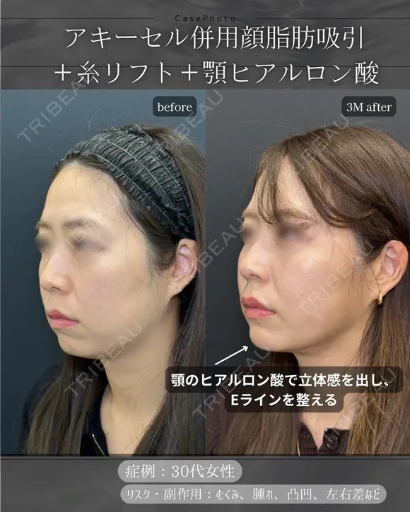 顔脂肪吸引、糸リフト、ヒアルロン酸注入(顎) after画像 メイン用