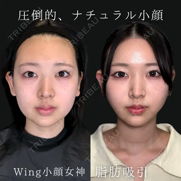 Wing小顔女神脂肪吸引 before画像 メイン用