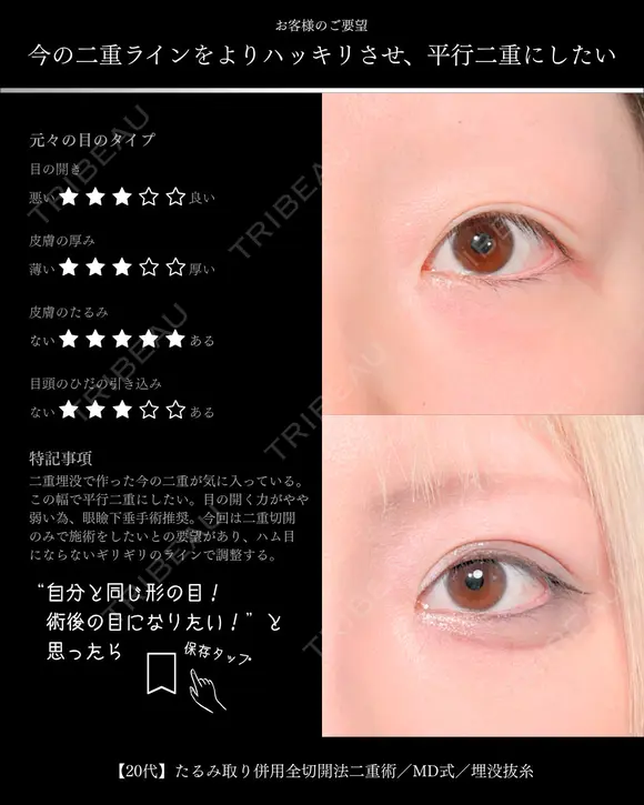 たるみ取り併用全切開法二重術/MD式/埋没抜糸 before画像 メイン用