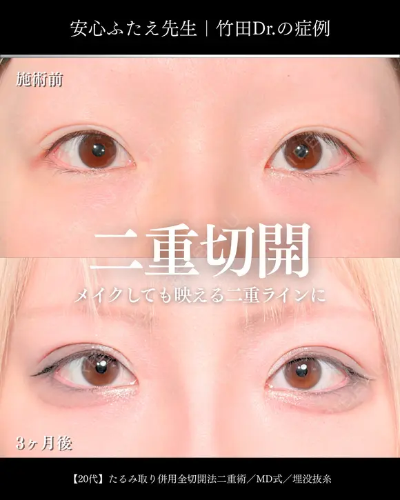 たるみ取り併用全切開法二重術/MD式/埋没抜糸 90日後 メイン用