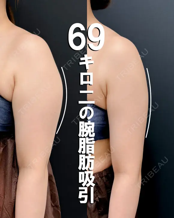 ベイザー併用アキーセル二の腕脂肪吸引 before画像 メイン用