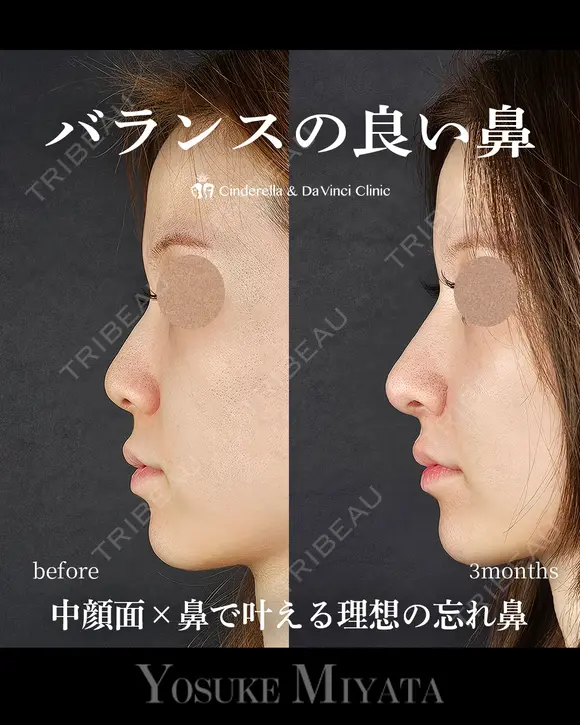 バランスの良い鼻 before画像 メイン用