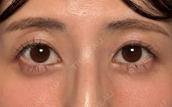目のくぼみ改善！目の上ヒアルロン酸 before画像 メイン用