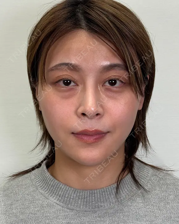 術後からスッキリ♪目の下クマ取り before画像 メイン用