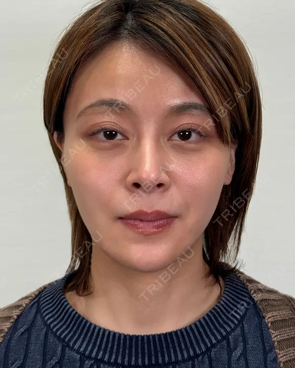 術後からスッキリ♪目の下クマ取り 30日後 メイン用