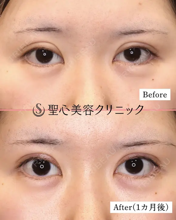 【20代女性・ハム目を治す】睫毛上皮膚切除（術後1ヶ月） 30日後 メイン用
