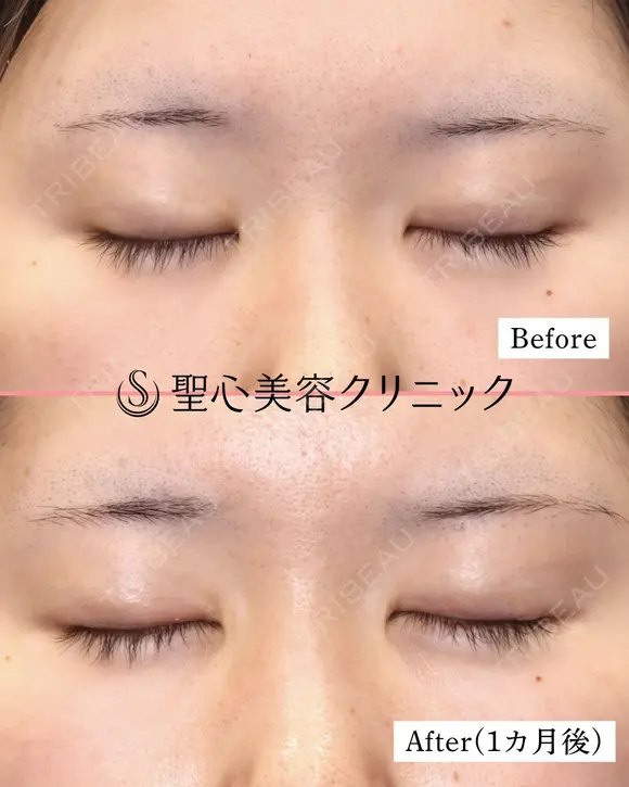 【20代女性・ハム目を治す】睫毛上皮膚切除（術後1ヶ月） after画像 メイン用