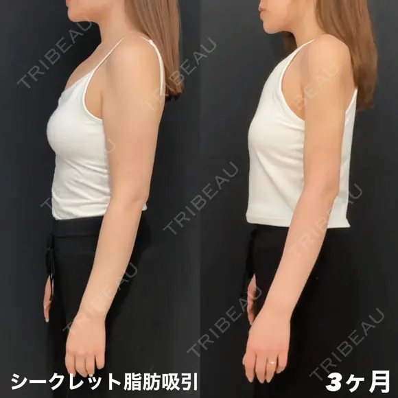 シークレット脂肪吸引二の腕 before画像 メイン用