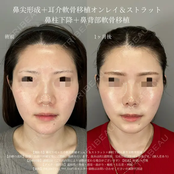 鼻尖形成・軟骨移植・鼻背部軟骨移植・鼻柱下降術 before画像 メイン用