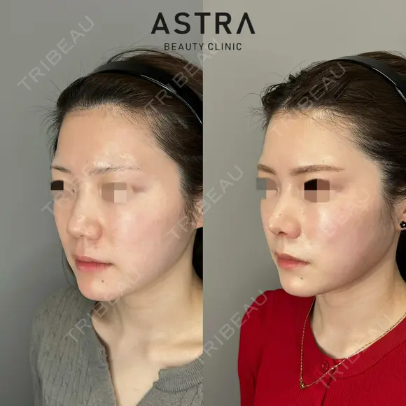 鼻尖形成・軟骨移植・鼻背部軟骨移植・鼻柱下降術 after画像 メイン用