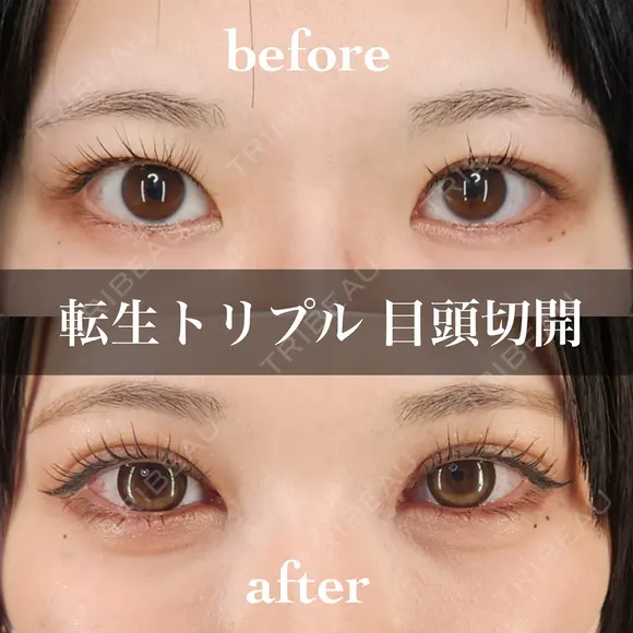 二重埋没＋目頭切開 before画像 メイン用