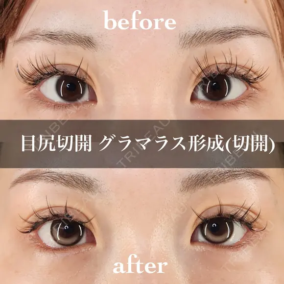 目尻切開＋グラマラス形成（切開） 30日後 メイン用
