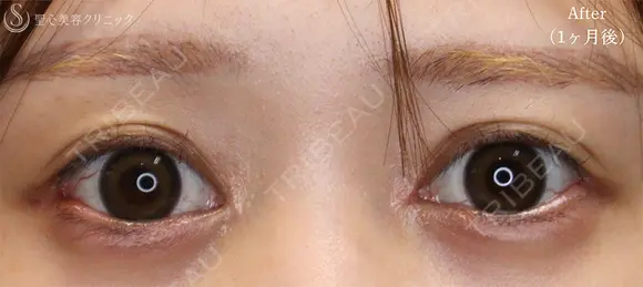【20代女性・目頭と目尻の相乗効果で目を大きく】目頭切開＋目尻切開（1ヶ月後） 30日後 メイン用