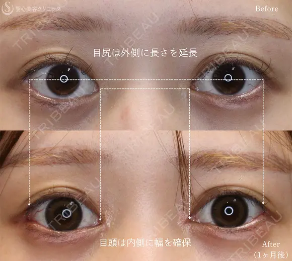 【20代女性・目頭と目尻の相乗効果で目を大きく】目頭切開＋目尻切開（1ヶ月後） 30日後 メイン用