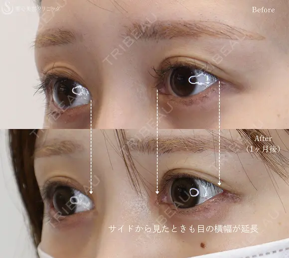 【20代女性・目頭と目尻の相乗効果で目を大きく】目頭切開＋目尻切開（1ヶ月後） 30日後 メイン用