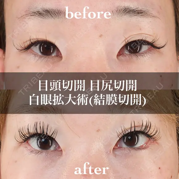 目頭切開＋目尻切開＋白眼拡大術（結膜切開） before画像 メイン用