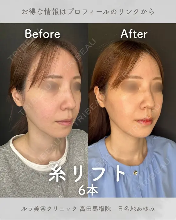 糸リフト6本 before画像 メイン用
