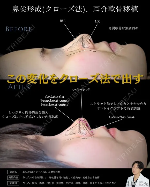 【鼻整形】鼻尖形成クローズ法＋耳介軟骨移植 before画像 メイン用