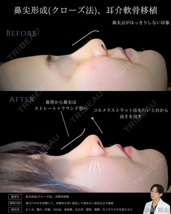 【鼻整形】鼻尖形成クローズ法＋耳介軟骨移植 after画像 メイン用