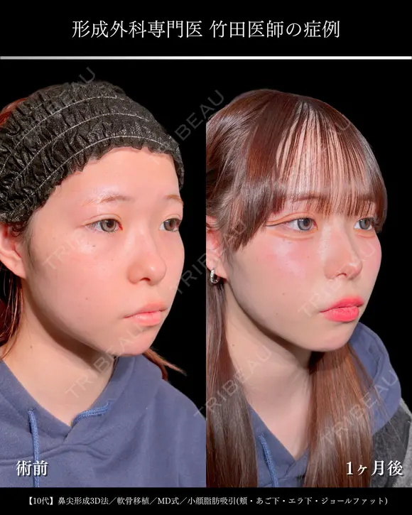 小顔脂肪吸引(頬+あご下+エラ下+ジョールファット)/鼻尖形成3D法/軟骨移植/MD式/ before画像 メイン用