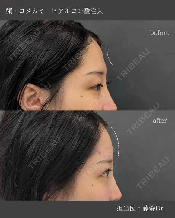 【額・コメカミ】ヒアルロン酸注入 before画像 メイン用