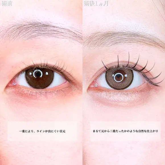 アリエルクイックループトリプル二重埋没法/涙袋ヒアルロン酸 before画像 メイン用