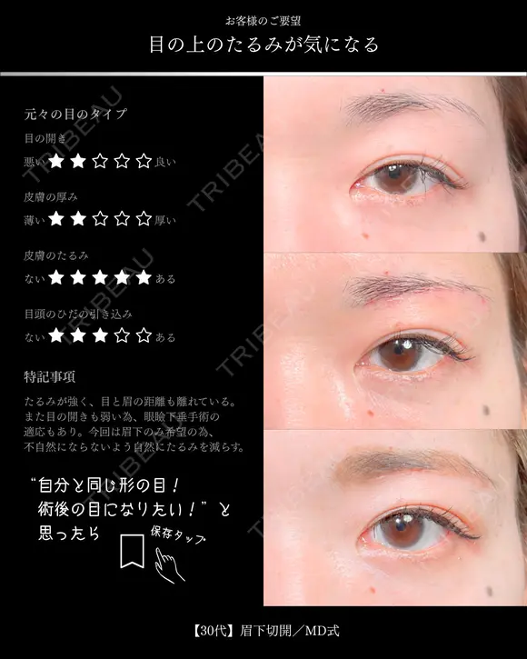 眉下切開/MD式 before画像 メイン用