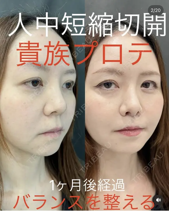 人中短縮＋貴族手術 before画像 メイン用
