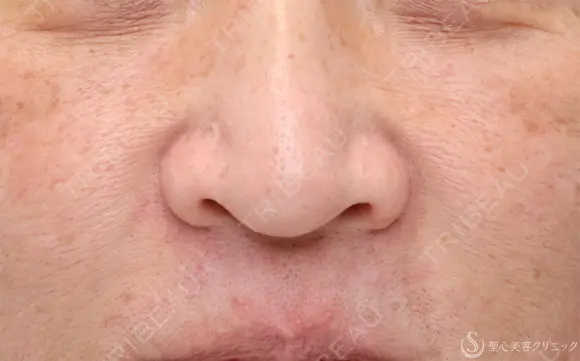 【50代女性・自然な小鼻に】小鼻縮小術（1ヶ月後） before画像 メイン用