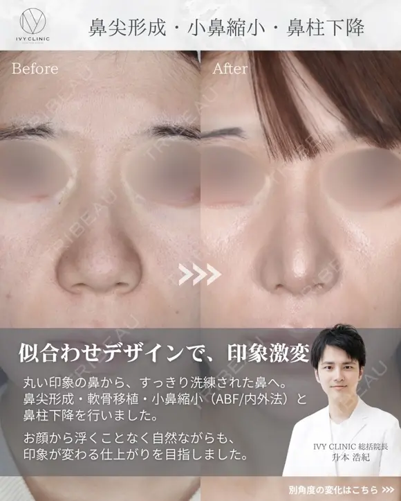 鼻尖形成　小鼻縮小　鼻柱下降 before画像 メイン用